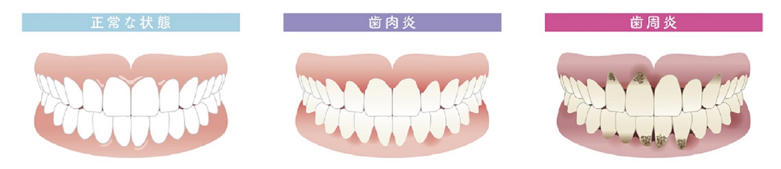 下がっ た 歯茎 戻る